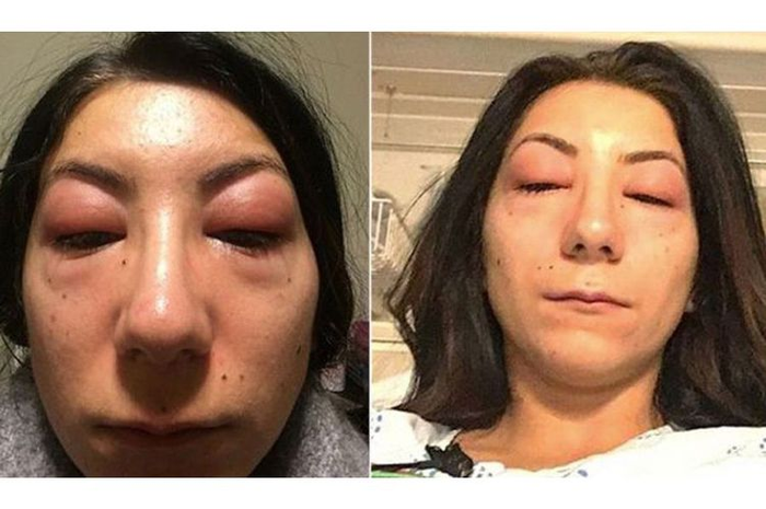 Demi mewujudkan keinginannya memiliki bulu mata panjang, wanita ini melakukan penyambungan bulu mata. Namun, matanya mengalami alergi dan bengkak parah.