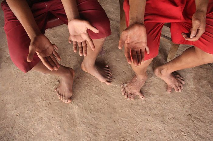 Karena kelainan genetik yang telah jadi turunan dari ibu dan nenek mereka, dua bersaudara ini punya jemari tangan dan kaki hingga belasan. Seperti ini bentuknya