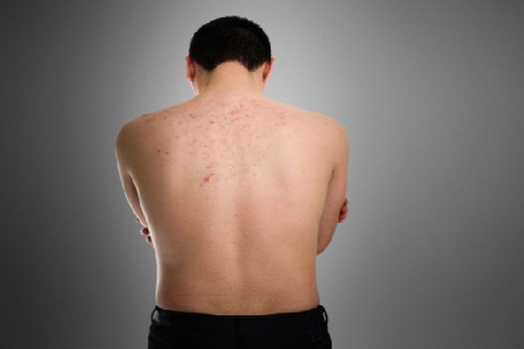 Awas, Jerawat Kini Ada di Punggung Juga! Hindari 7 Kebiasaan yang Bisa