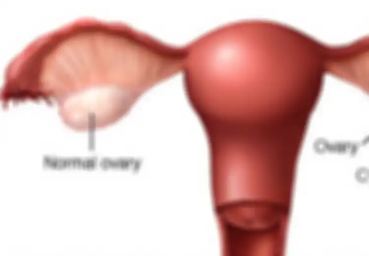 Nyeri Perut Tak Kunjung Sembuh,  Ternyata Kista Ovarium Sebesar 18 Kg Tumbuh di Perut Wanita India Ini Sampai Sulit Napas