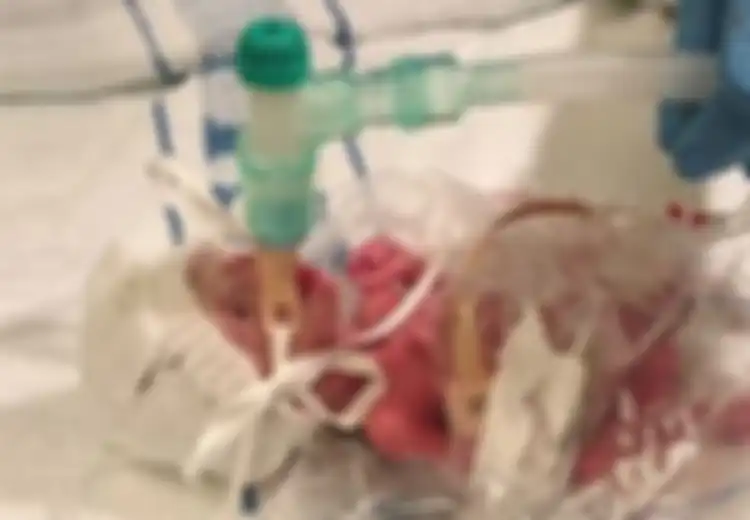 Selamat dari Maut, Bayi Berbobot 500 Gram Ini Buktikan Keajaiban Itu Ada, Lihat Kondisinya Setelah 2 Tahun