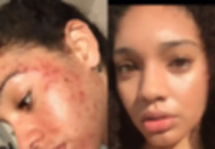 Wanita Ini Berhasil Obati Jerawatnya Selama 30 Hari, Perawatan Alaminya Ini Kini Banyak Ditiru Orang