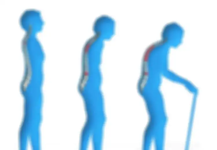 Pria Harus Waspada, 6 Faktor Ini Memperbesar Kemungkinan Anda Terserang Osteoporosis