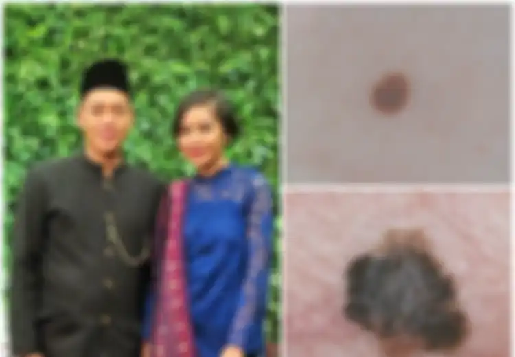 Waahh… Ternyata yang Sering Digunakan Memasak Ini Bisa Jadi Penyebab Kanker Kulit yang Renggut Nyawa Menantu Hatta Rajasa, Hati-hati!