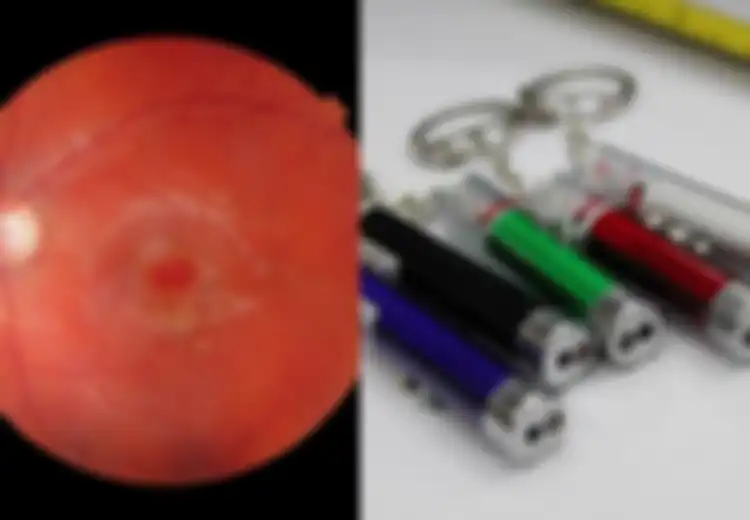 Jangan Sepelekan Pulpen Laser, Mata Anak Ini Berlubang Akibat Bermain Pulpen Laser