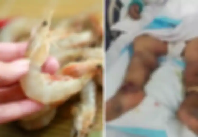 Hanya Karena Jari yang Tergores Saat Bersihkan Udang, Perempuan Ini Alami Infeksi Hingga Berujung Kematian