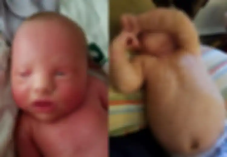 Bak Ular, Kulit Bayi Ini Menebal dan Berganti Setiap Minggu, Ternyata Ini Penyebabnya