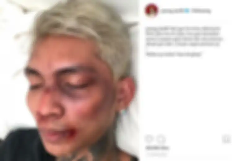 Young Lex Unggah Foto Babak Belur Dihajar K-Popers Garis Keras, Ternyata Semua Hanya HOAX