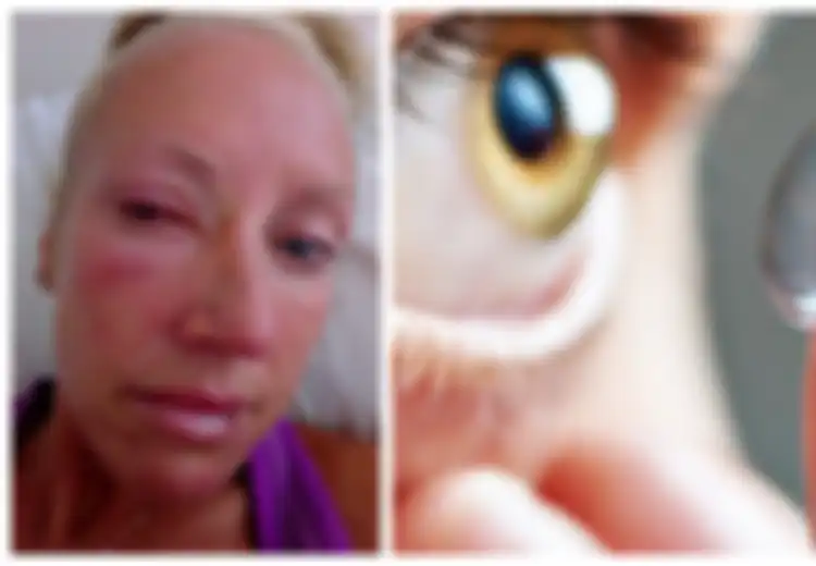 Tragis, Pakai Contact Lens Saat Mandi,  Wanita Ini Kehilangan Penglihatannya