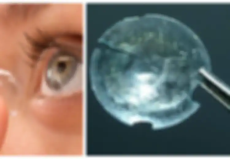 Ngeri, Wanita Ini 'Menyimpan' Contact Lens Di Balik Kelopak Matanya Selama 28 Tahun