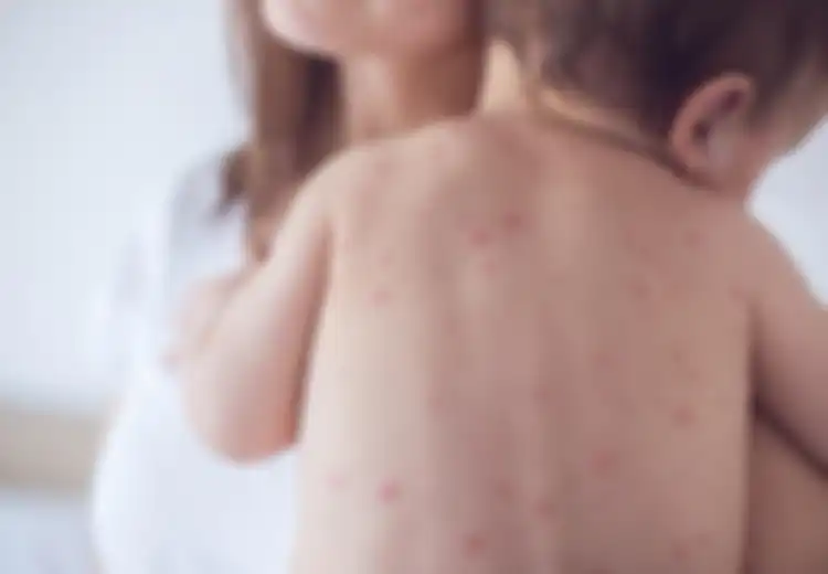 Imunisasi MR Ditunda: Apa Itu Rubella, Gejala Serta Pencegahannya?