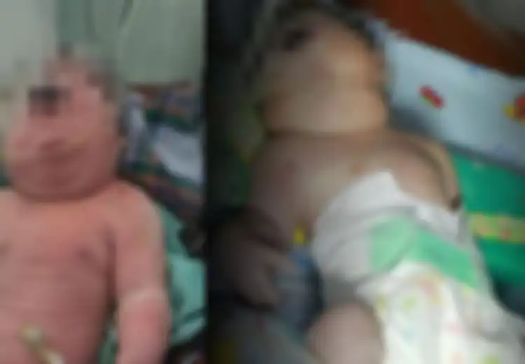 8 Fakta Bayi Bermata Satu di Mandailing Natal, Saat Lahir Tidak Menangis