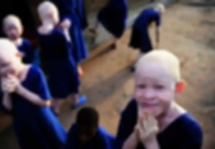 Kehidupan Tragis Orang Albino di Afrika, Jadi Buruan karena Bagian Tubuhnya Dianggap 'Bertuah'