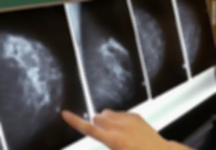 Dapat Donor Organ dari Orang yang Sama, 4 Pasien Ini Terkena Kanker Payudara bahkan Ada yang Sampai Meninggal