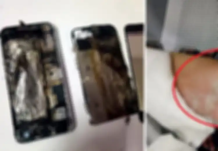 Gara-gara Mengisi Baterai HP Semalaman, Tangan Wanita ini Terbakar