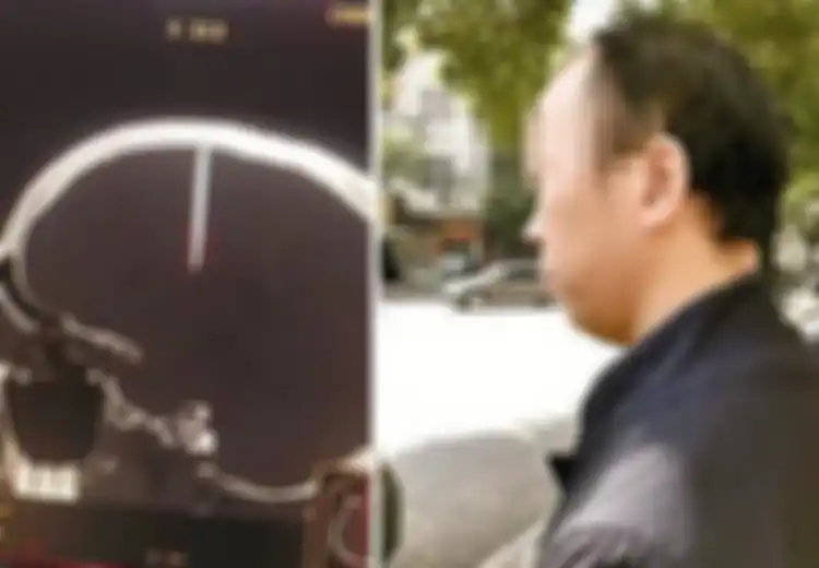 Dokter Temukan Paku Ukuran 4,8 cm di Kepala Pria yang Berulang Kali Mengeluh Sakit Kepala Ini, Mengerikan!