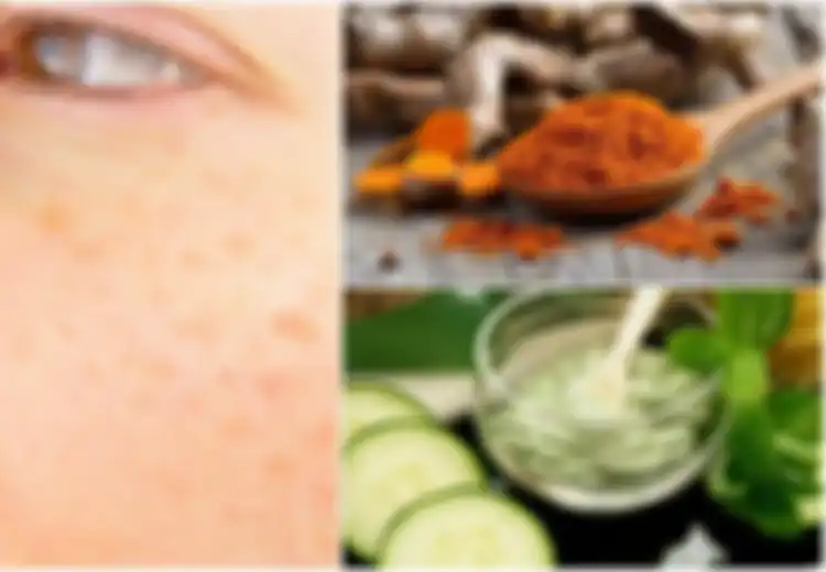 4 Obat Anti Flek Hitam karena Usia, Bisa Dibikin Sendiri Lho!