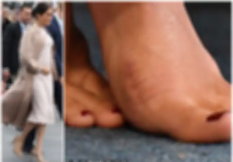 Bertelanjang Kaki, Meghan Markle Disebut Pernah Operasi Karena Bunion, Apa Itu?