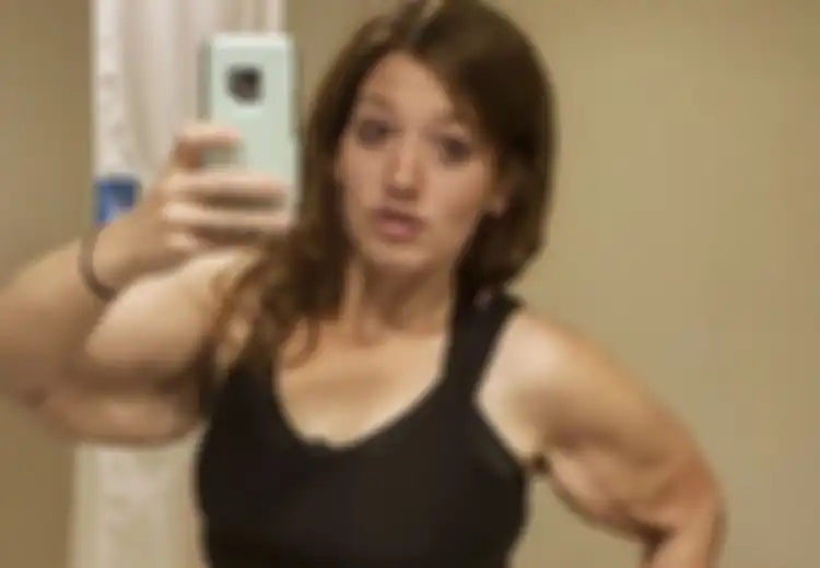 Sukses Turunkan Berat Badan 141 Kg, Lexi Reed Hadapi Mimpi Buruk dari Kulitnya yang Menggantung Seberat 3 Kg