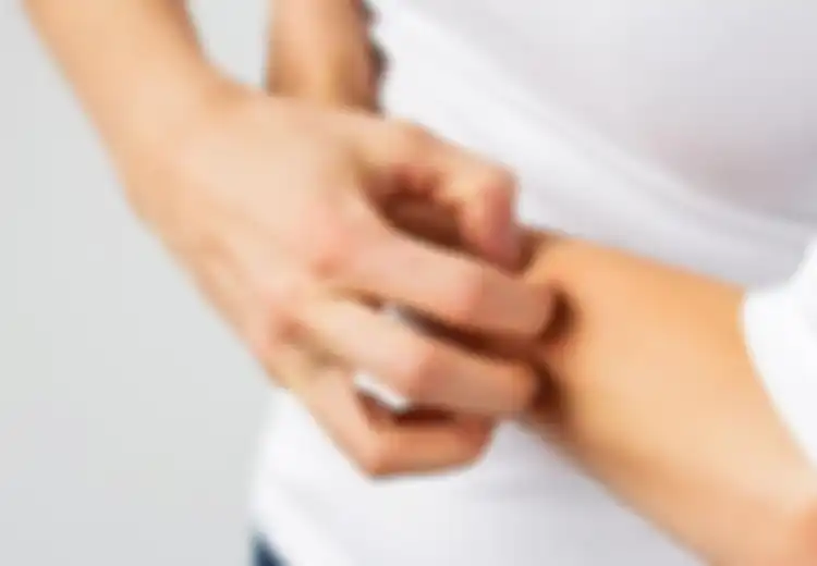 10 Alergi Tak Biasa, Ada Alergi Sperma, Kuku Palsu, Hingga Ponsel