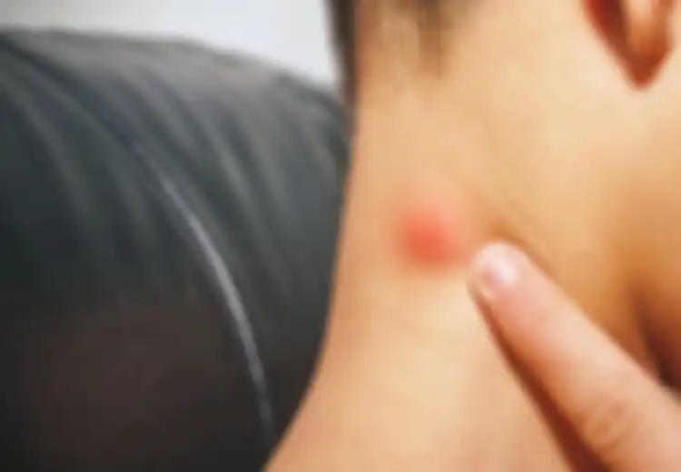 Miliki Benjolan di Beberapa Bagian Tubuh, Apakah Itu Tanda Infeksi atau Kanker? Begini Cara Mencari Tahunya