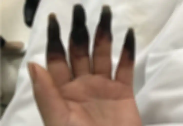 Jari-jarinya Berubah Menjadi Hitam Lebam Laiknya Membusuk, Penyakit Apa Ini?