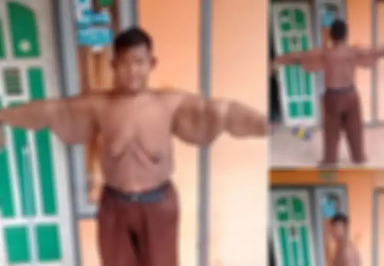 Mengenal Operasi Bariatrik yang Bantu Arya Turunkan Berat Badan Hingga 100 Kg