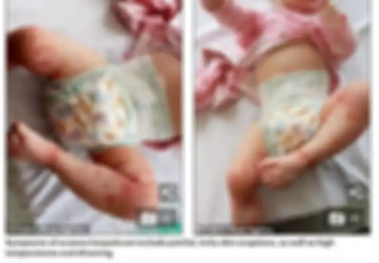 Hanya Karena Ciuman, Bayi 1 Tahun Ini Kena Ruam dan Hampir Kehilangan Nyawa, Peringatan Untuk Orangtua! 