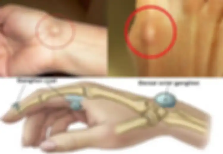 Pernah Temukan Benjolan Seperti Ini di Tangan atau Kaki? Awas, Mungkin Anda Menglami Kondisi Berikut