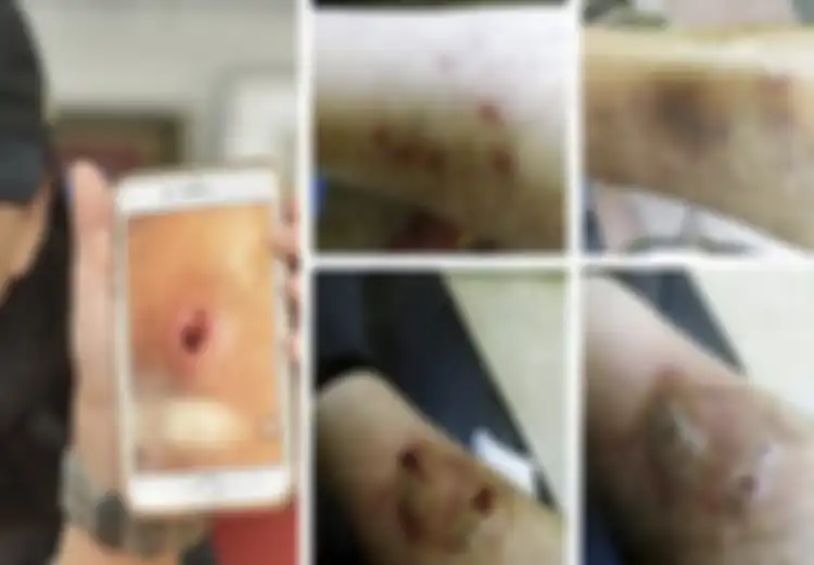 Sekumpulan Pria Mengalami Infeksi Mengerikan Setelah Mengunjungi Panti Pijat, Peringatan Bagi yang Suka Pijat Sembarangan
