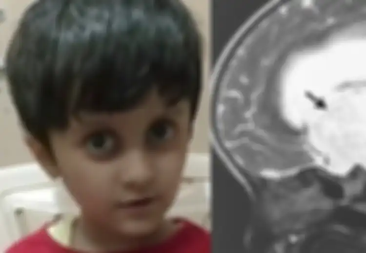 2 Tahun Tak Dapat Berhenti Anggukkan Kepala, Ternyata Ada Kista di Otak Anak 5 Tahun Ini