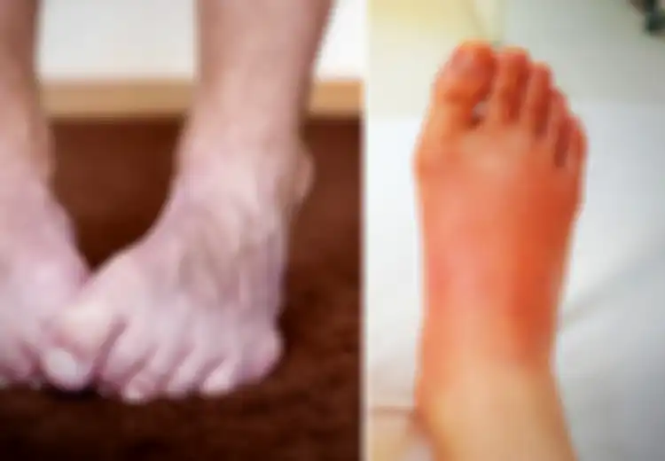 Ini 10 Gejala Kaki yang Ungkapkan Masalah Kesehatan Kita, Waspadalah!