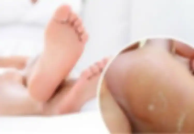 Obat Ampuh Terbaik Atasi Kapalan Kaki: Cuka dan Bawang Putih