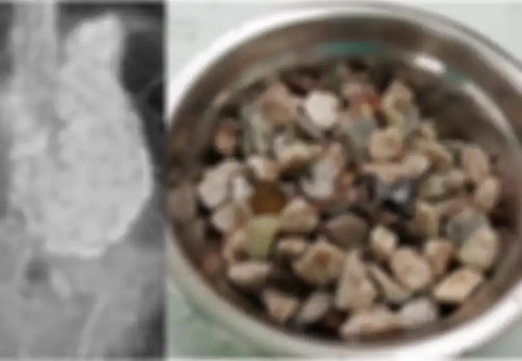 Seorang Pria Mengeluh Sakit Perut, Dokter Terkejut Temukan 2 Kg Batu, Koin, dan Tutup Botol dalam Perut Pria Tersebut