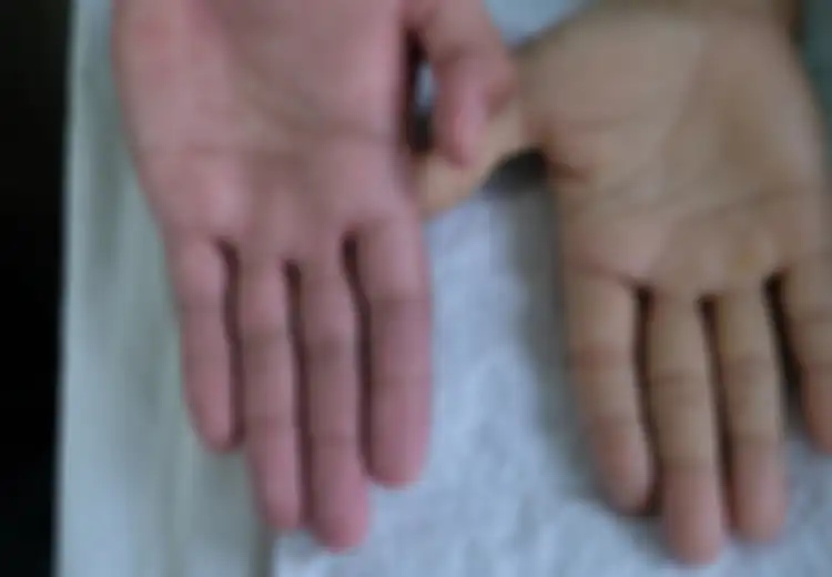Jangan Abaikan, Ini 6 Tanda Anemia dan Perawatan Alaminya!
