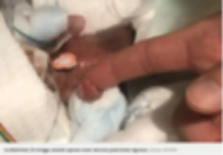 Ingat Dengan Bayi Terkecil Dunia Berbobot 268 Gram Ini? Seperti Inilah Kondisinya Sekarang Setelah Dirawat Berbulan-bulan