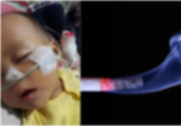 Gara-gara Ayahnya Perokok, Bayi Ini Derita Bronkopneumonia, Infeksi yang Mengancam Nyawa Bayi