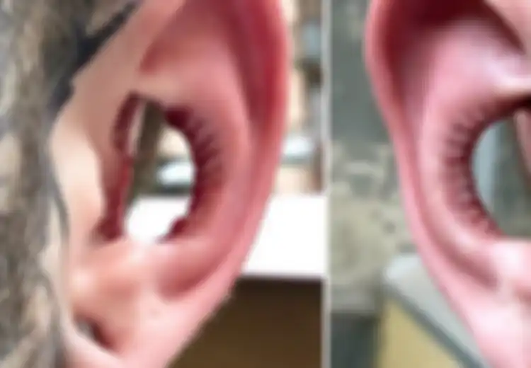 Conch Removal, Tren 'Melubangi' Bagian Tengah Telinga, Berani Coba?