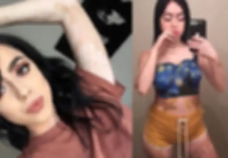Kerap Dibully Sebab Miliki Kulit dengan Vitiligo, Wanita Ini Buktikan Bahwa Kulitnya Cantik dengan Mengubahnya Jadi Karya Seni Unik