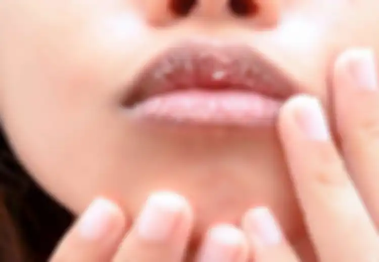Bibir Kering dan Pecah-pecah? Coba 7 Cara dengan Obat Rumahan Berikut Ini!
