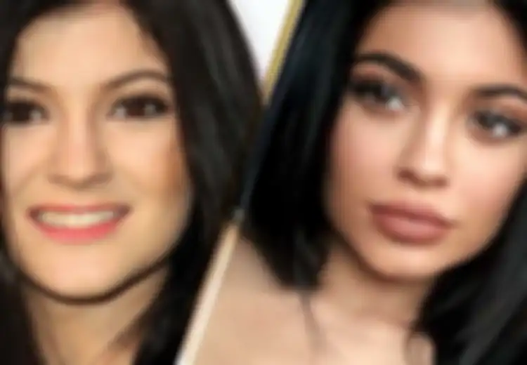 Duh, Wanita yang Pakai Filler Bibir Bisa Buta, Menderita Stroke, dan Cacat Permanen