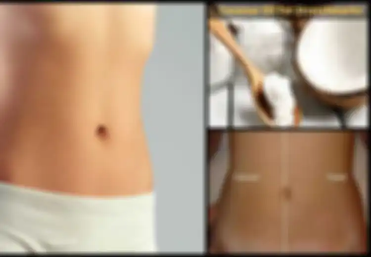 Ingin Hilangkan Stretch Mark? Ini 4 Cara Minyak Kelapa Mengatasinya!