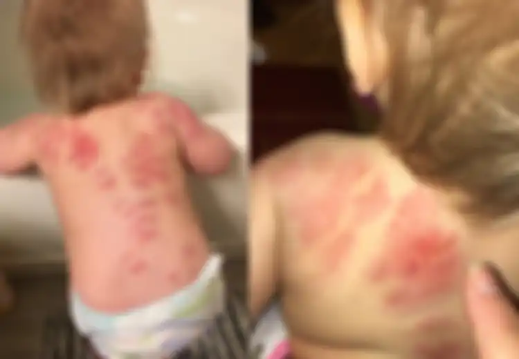 Ditemukan Lebih dari 25 Bekas Gigitan di Punggung Bayi Ini Setelah Ibunya Mengambilnya dari Tempat Penitipan Anak