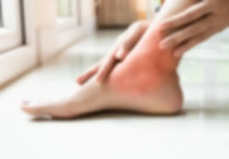 Penderita Diabetes Wajib Pantau Kakinya, Awas Risiko Diabetic Foot