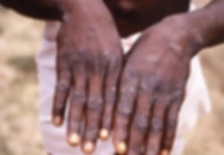 Warning! Singapura Negara Kecil yang Bersih Diserang Virus Monkeypox