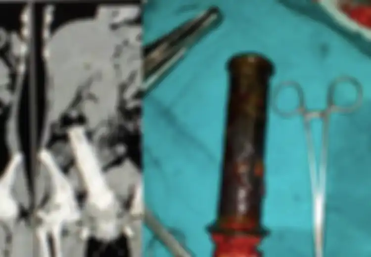 Suami Paksa Handle Motor Masuk ke Tubuh Istri Selama 2 Tahun: Ini 7 Benda Mengerikan yang Pernah Bersarang di Tubuh Manusia