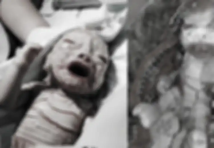 Terlahir dengan Kondisi Memilukan, Bayi Dania Mampu Bertahan, Seperti Inilah Kondisinya Kini
