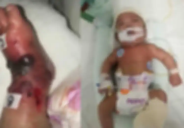 'Salah Tusuk' Saat Transfusi Darah, Kaki Seorang Bayi Jadi Bengkak, Doketr dan Perawat Saling Menyalahkan
