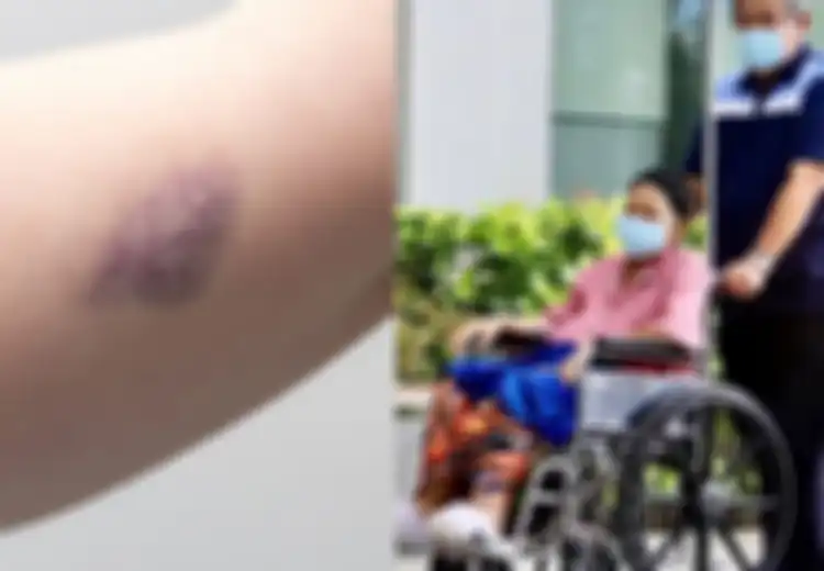 Ani Yudhoyono Tak Sadarkan Diri: Ini 5 Gejala Leukemia yang Sering Kali Diabaikan, Salah Satunya Memar di Tubuh
