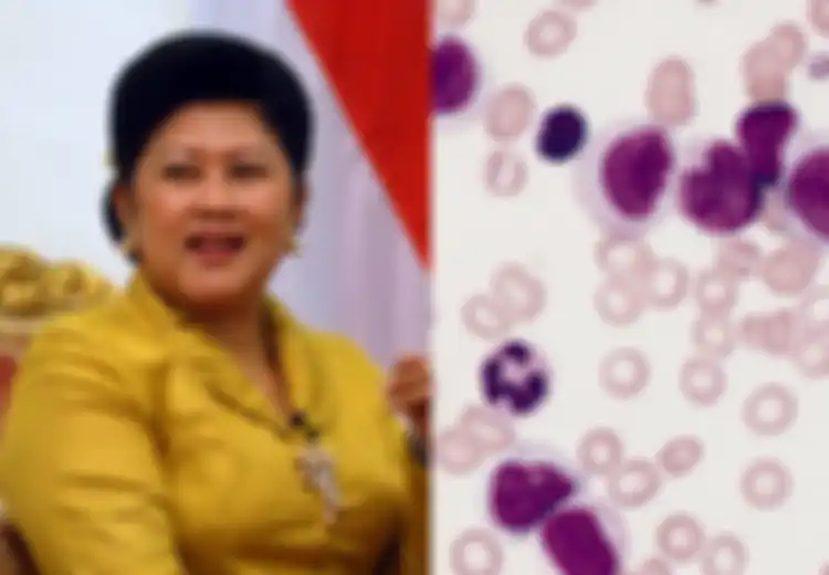 Ani Yudhoyono Meninggal Dunia: Ternyata Sel Leukemia Bisa 'Diatur' Agar Hancurkan Dirinya Sendiri, Ini Caranya!